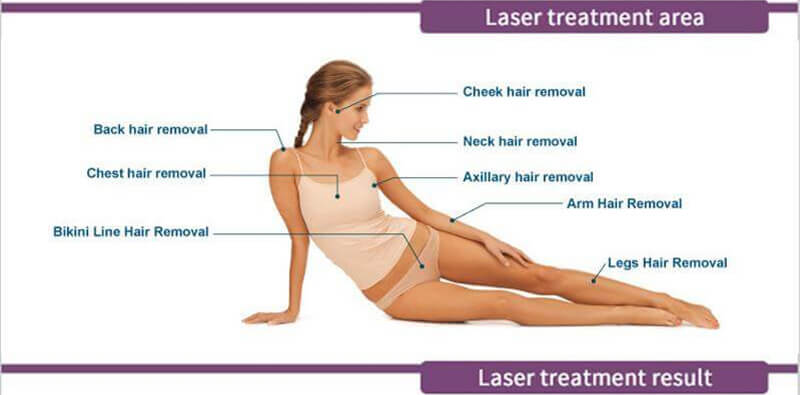 diode laser hair removal machine-4