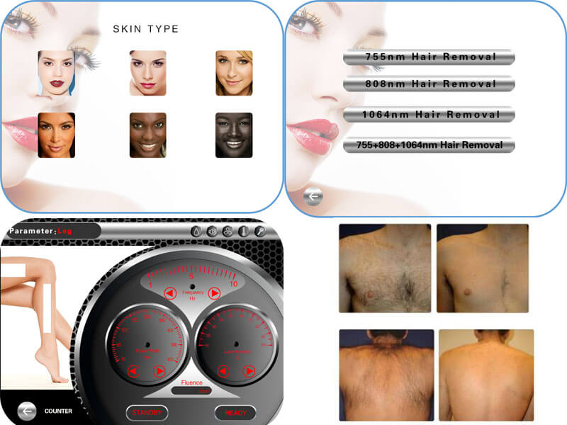 diode-laser-hair-removal-machine (1)