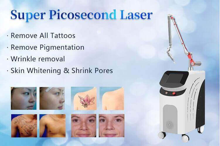 laser de picosegundos tatuajes